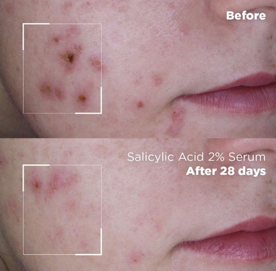 Skin Republic Salicylic Acid 2% Serum